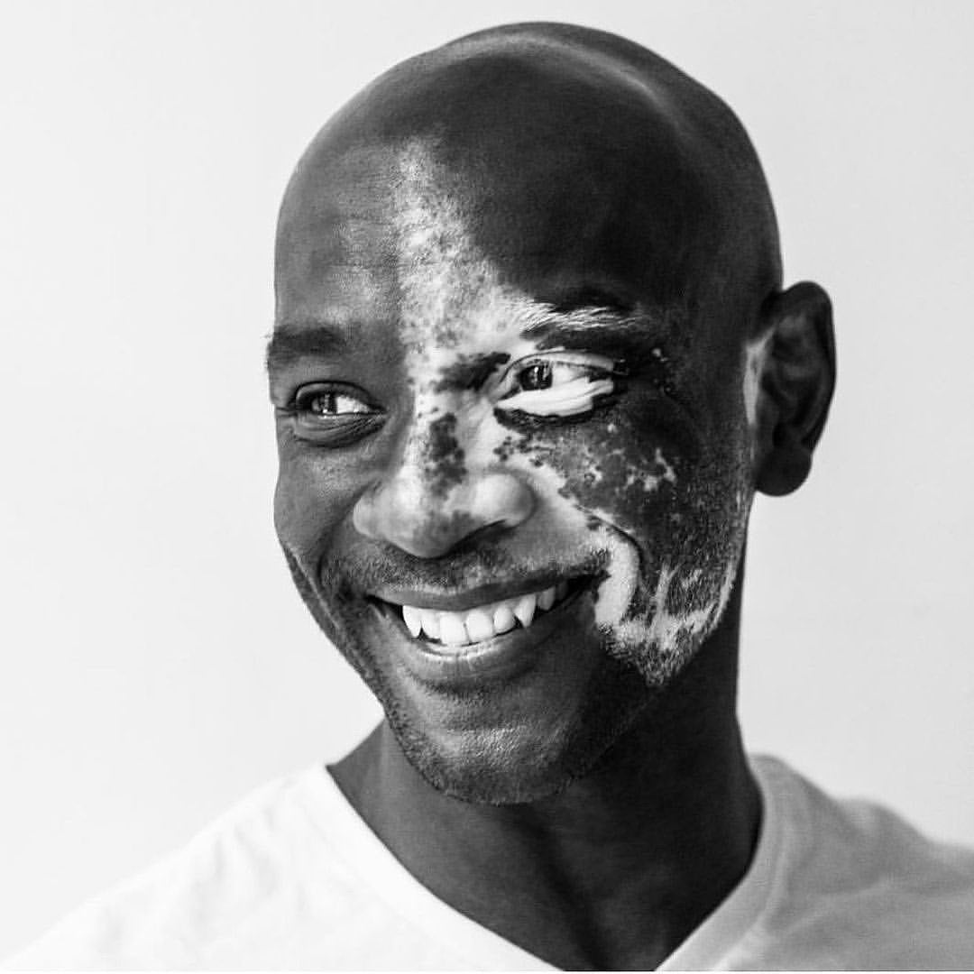 Black and white portrait of That Vitiligo Guy